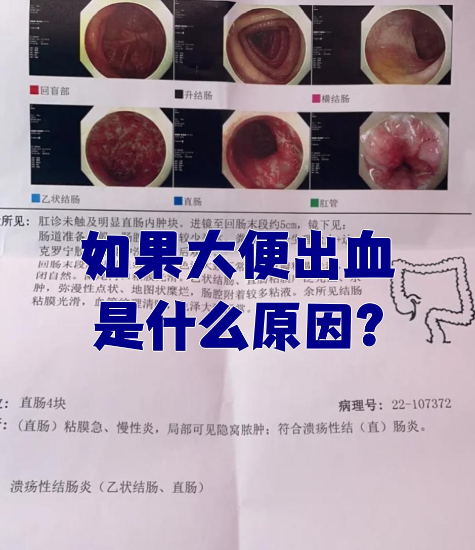 每次大便都出血,去年还没有痔疮的,图片