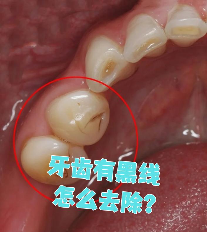 牙齿黑了有可以治疗吗