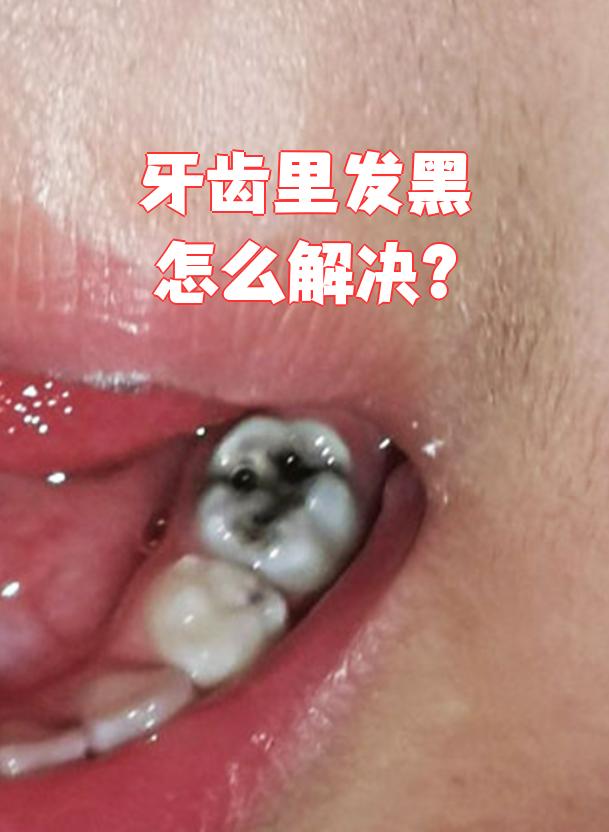牙齿黑了有可以治疗吗
