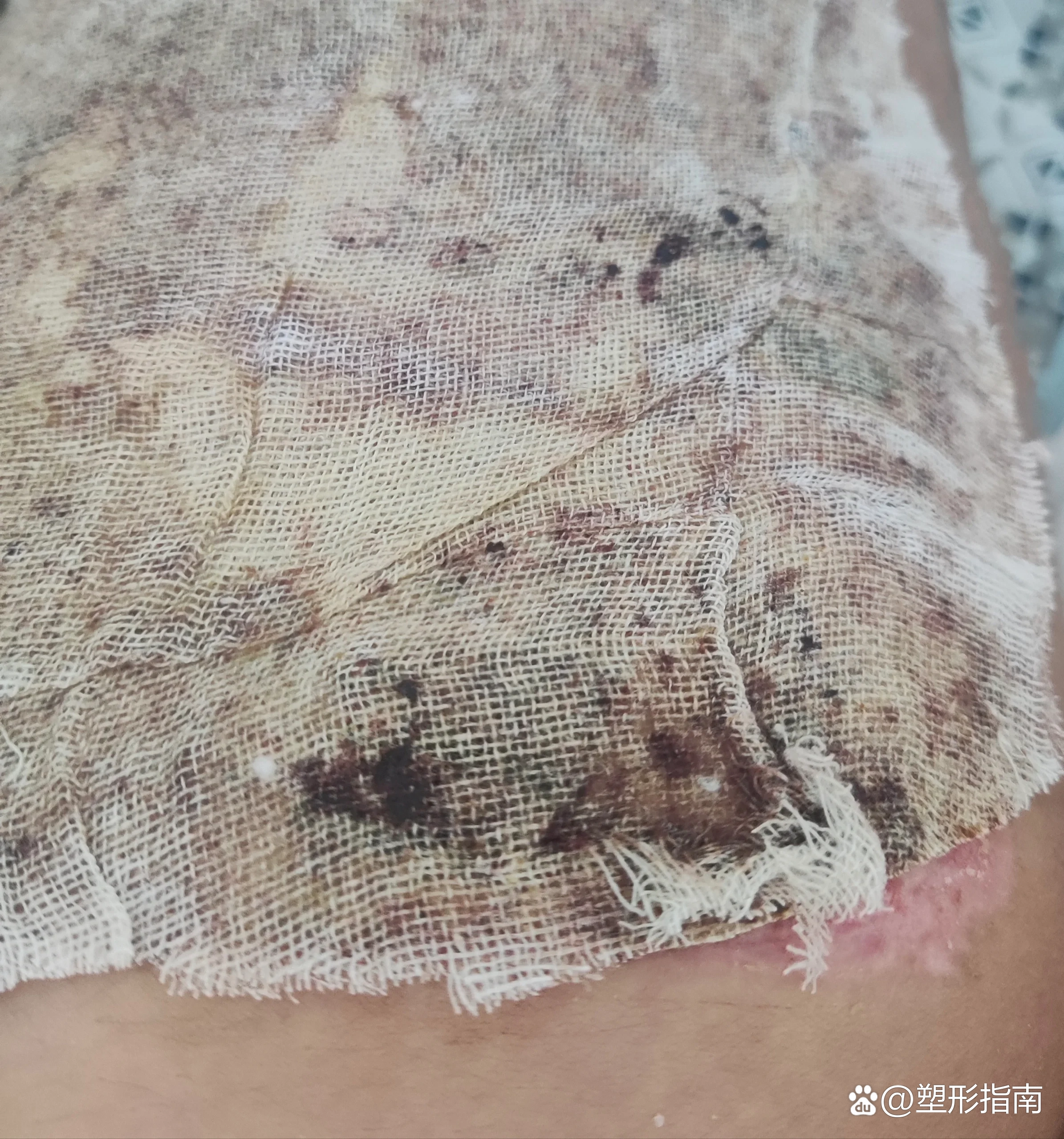 脚背植皮1个月恢复情况