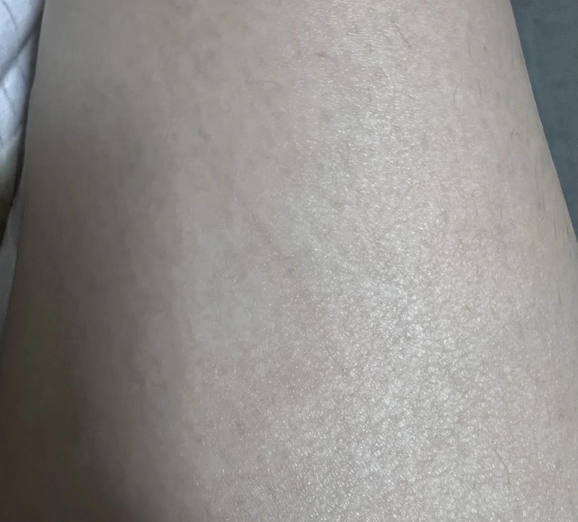 被狗抓伤了,有红印子,没出血