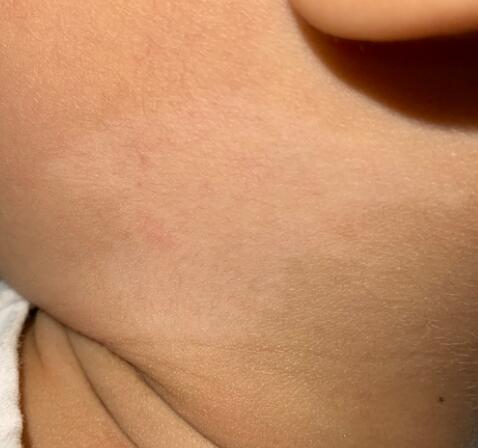 无色素痣是怎么回事