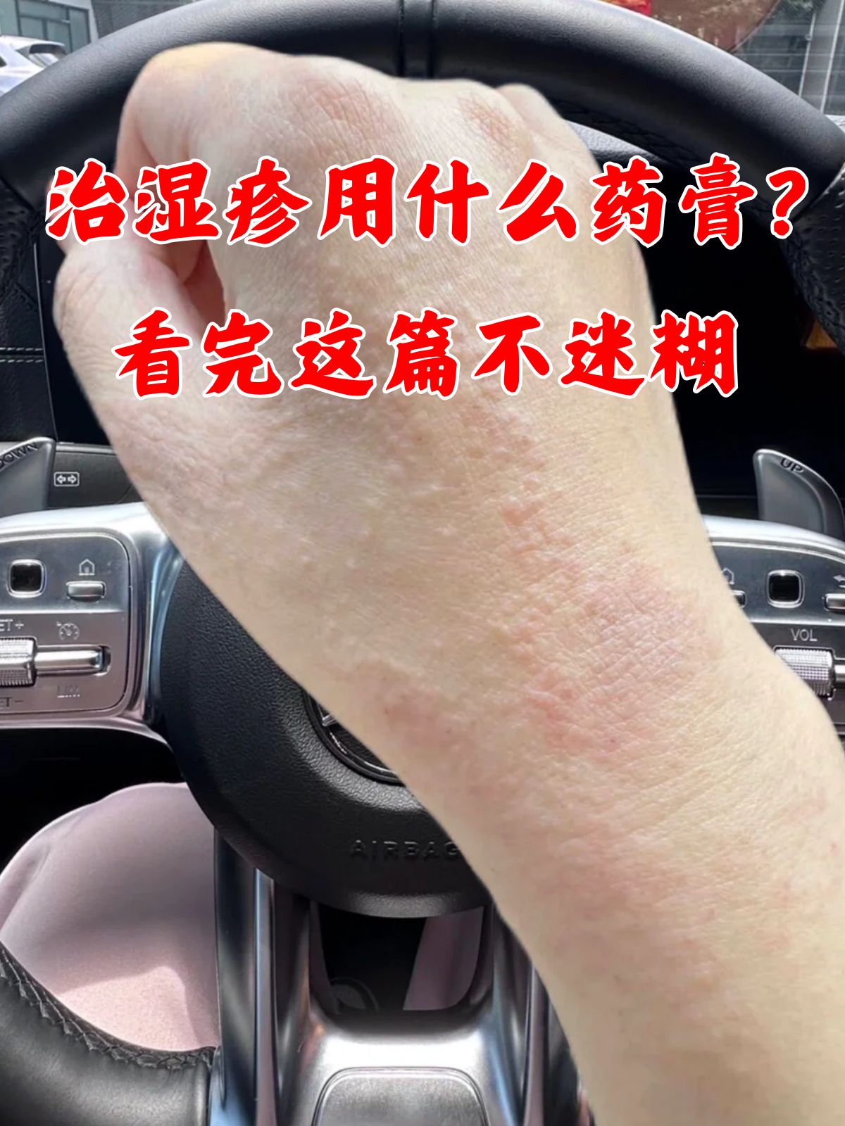 湿疹有什么症状