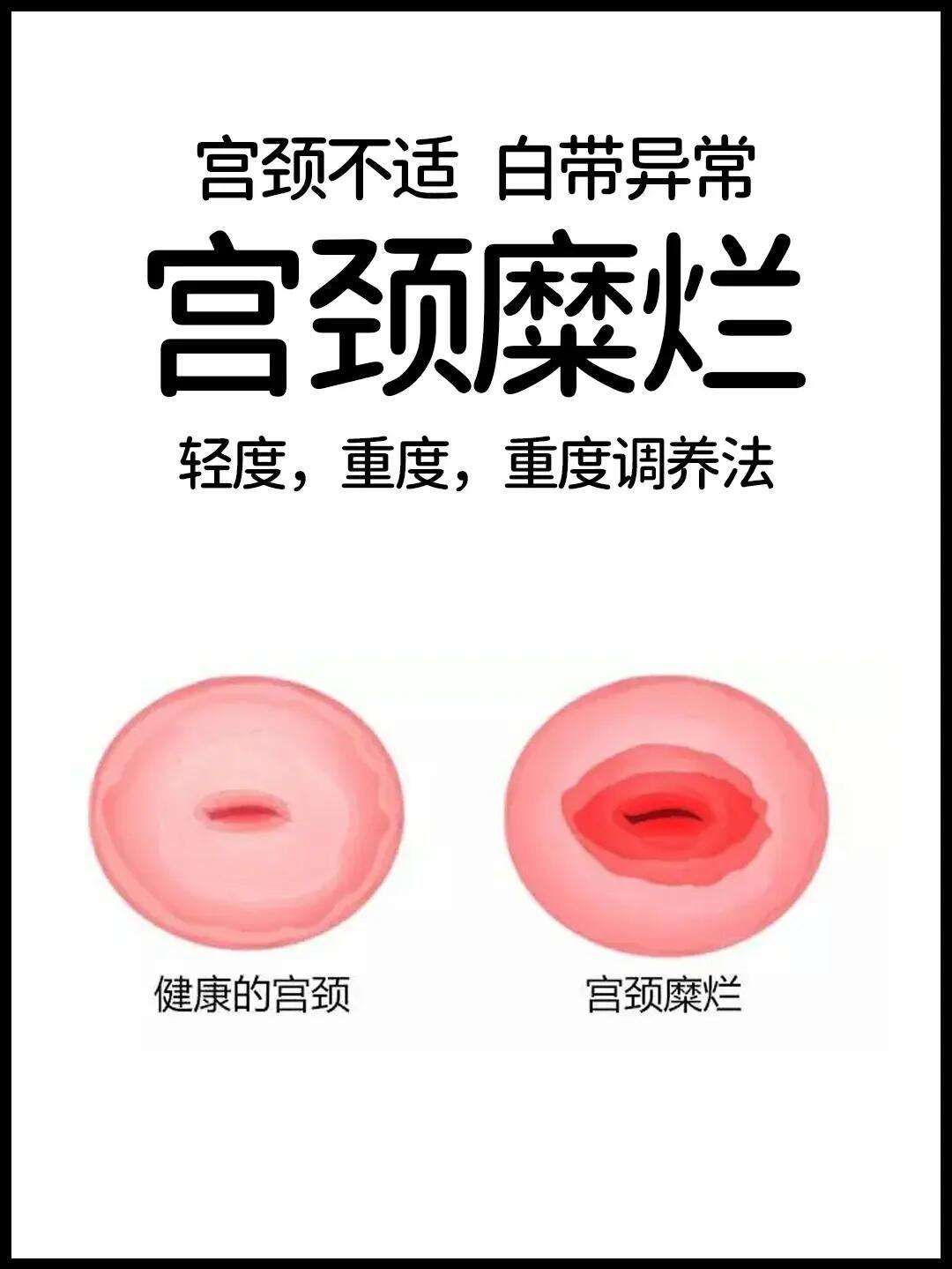 宫颈糜烂一度怎么办