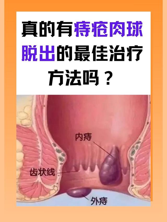 孕晚期痔疮脱出