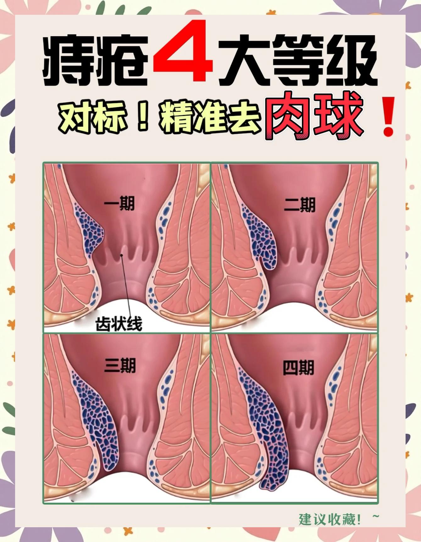 孕晚期痔疮脱出