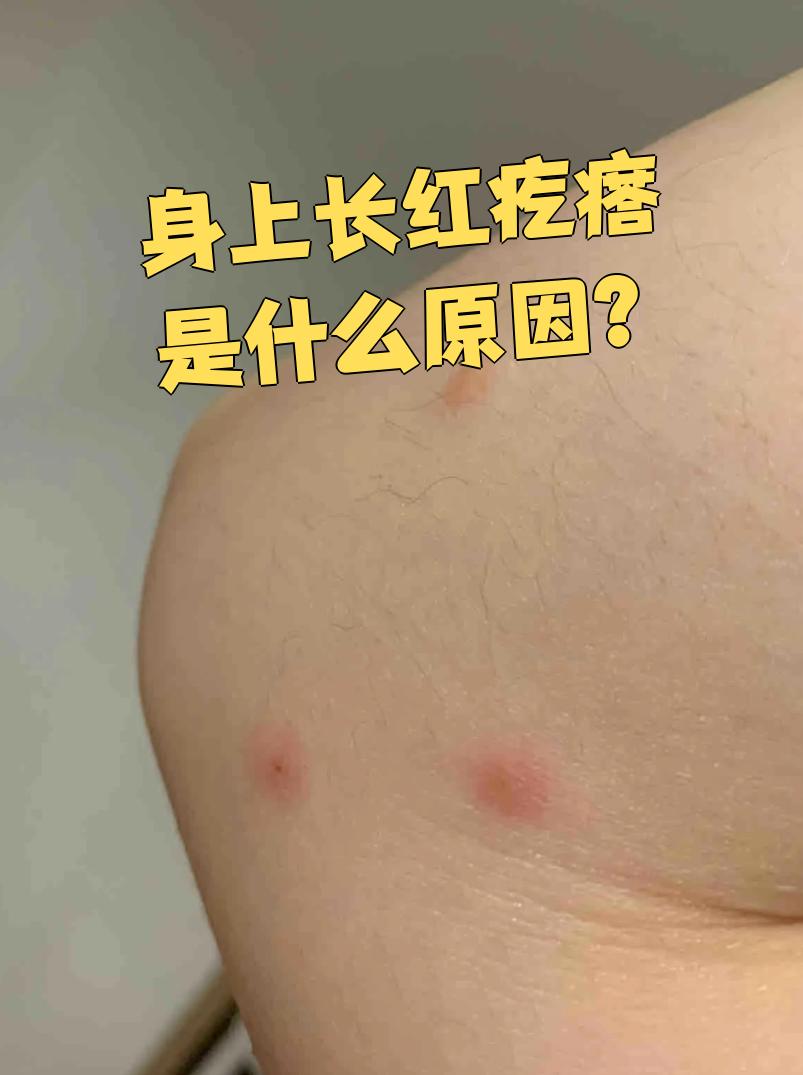 身上痒起疙瘩是怎么回事