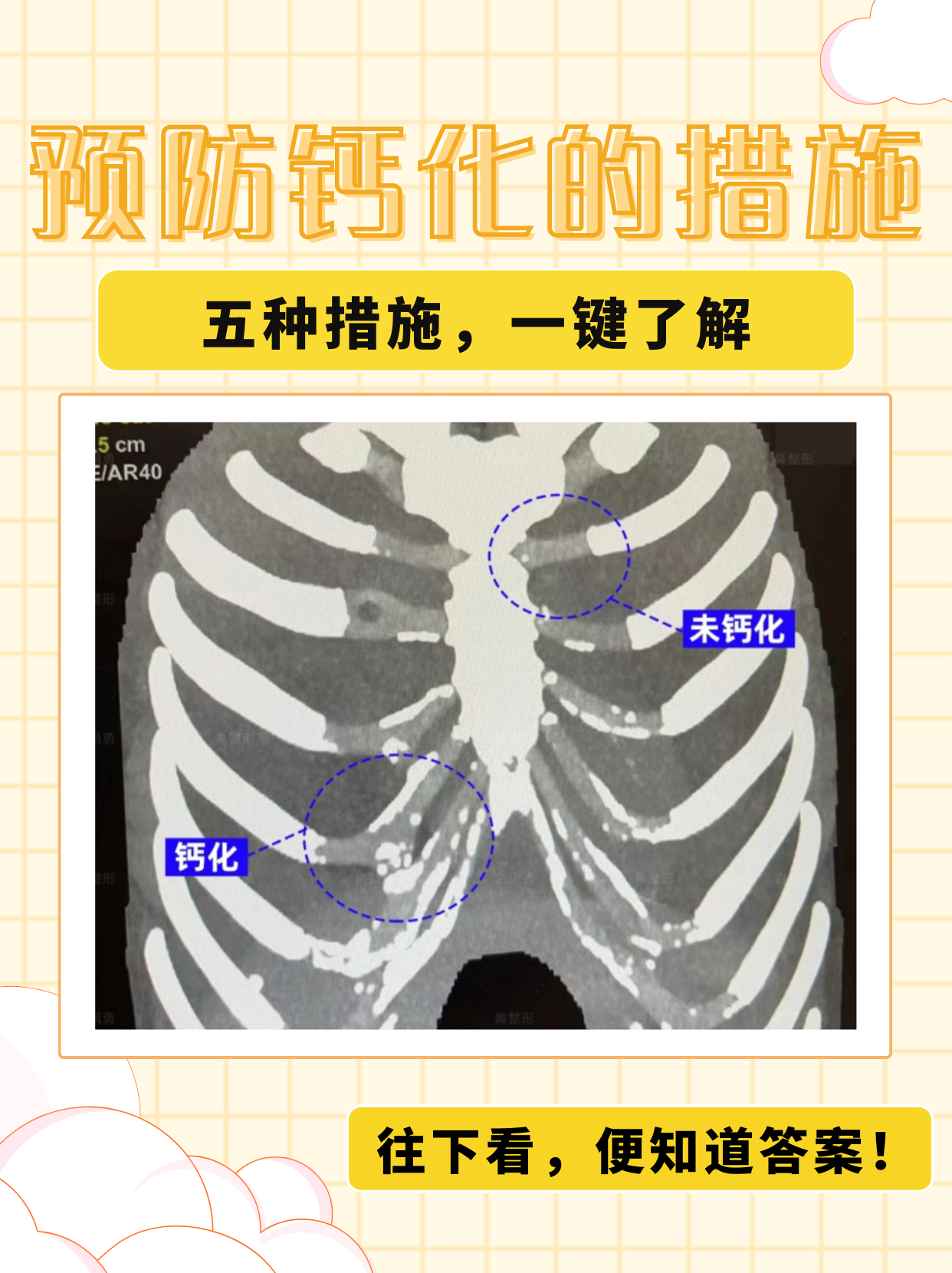 钙化灶严重吗