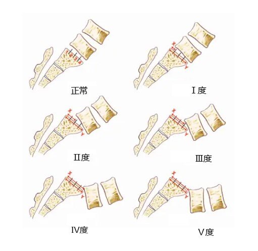 腰椎滑脱是什么