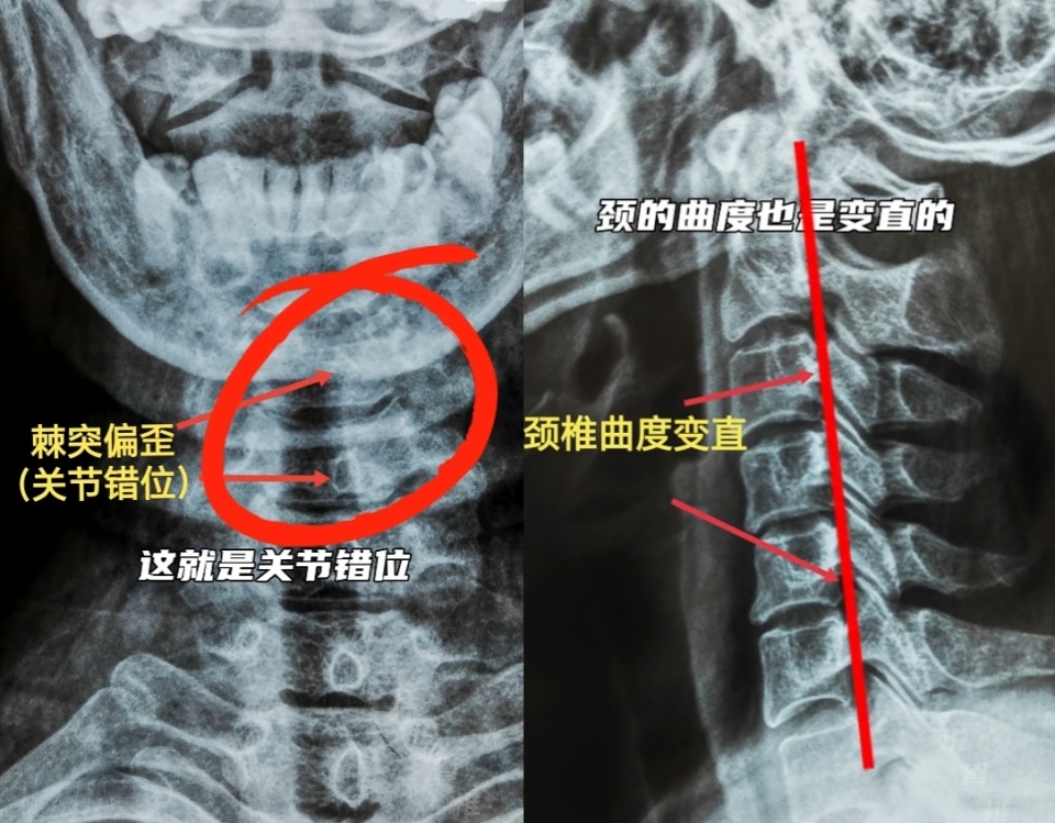 颈椎变直后还能恢复吗?