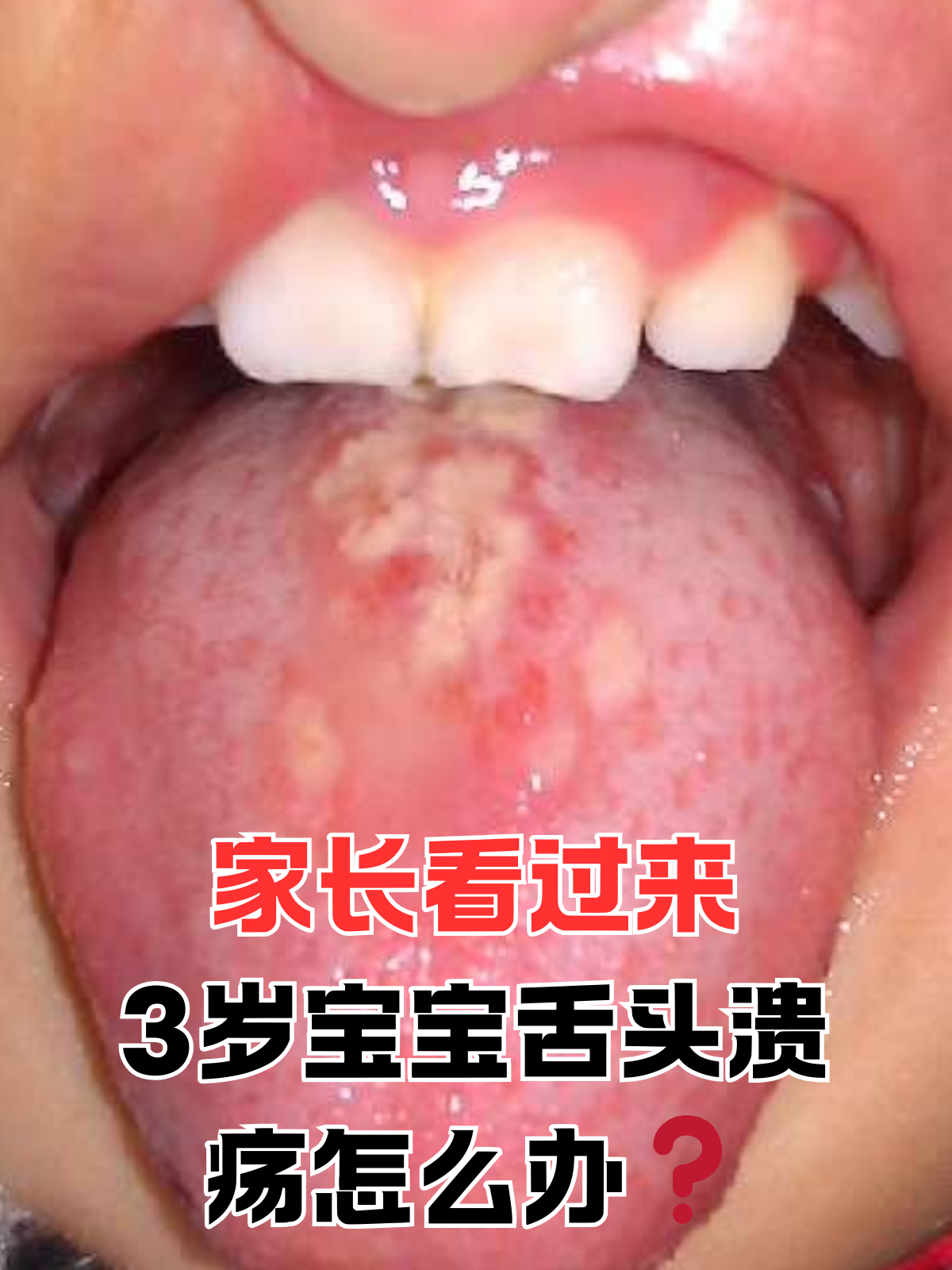 宝宝嘴里溃疡怎么办
