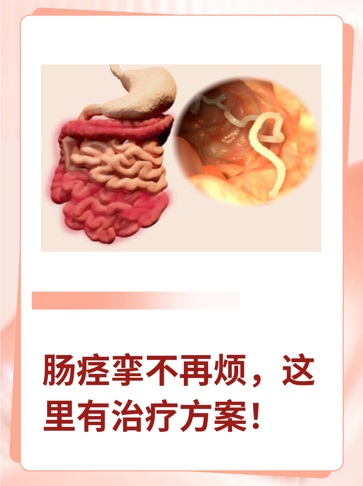 肠痉挛什么症状