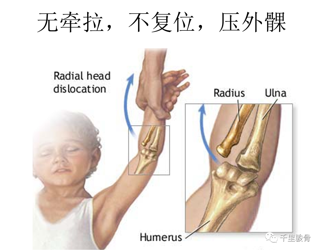 桡骨小头半脱位,怎么治疗
