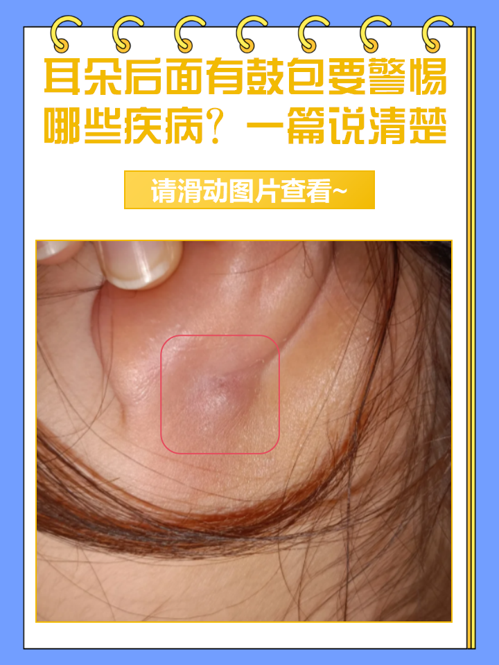 宝宝左耳朵后面有个小鼓包
