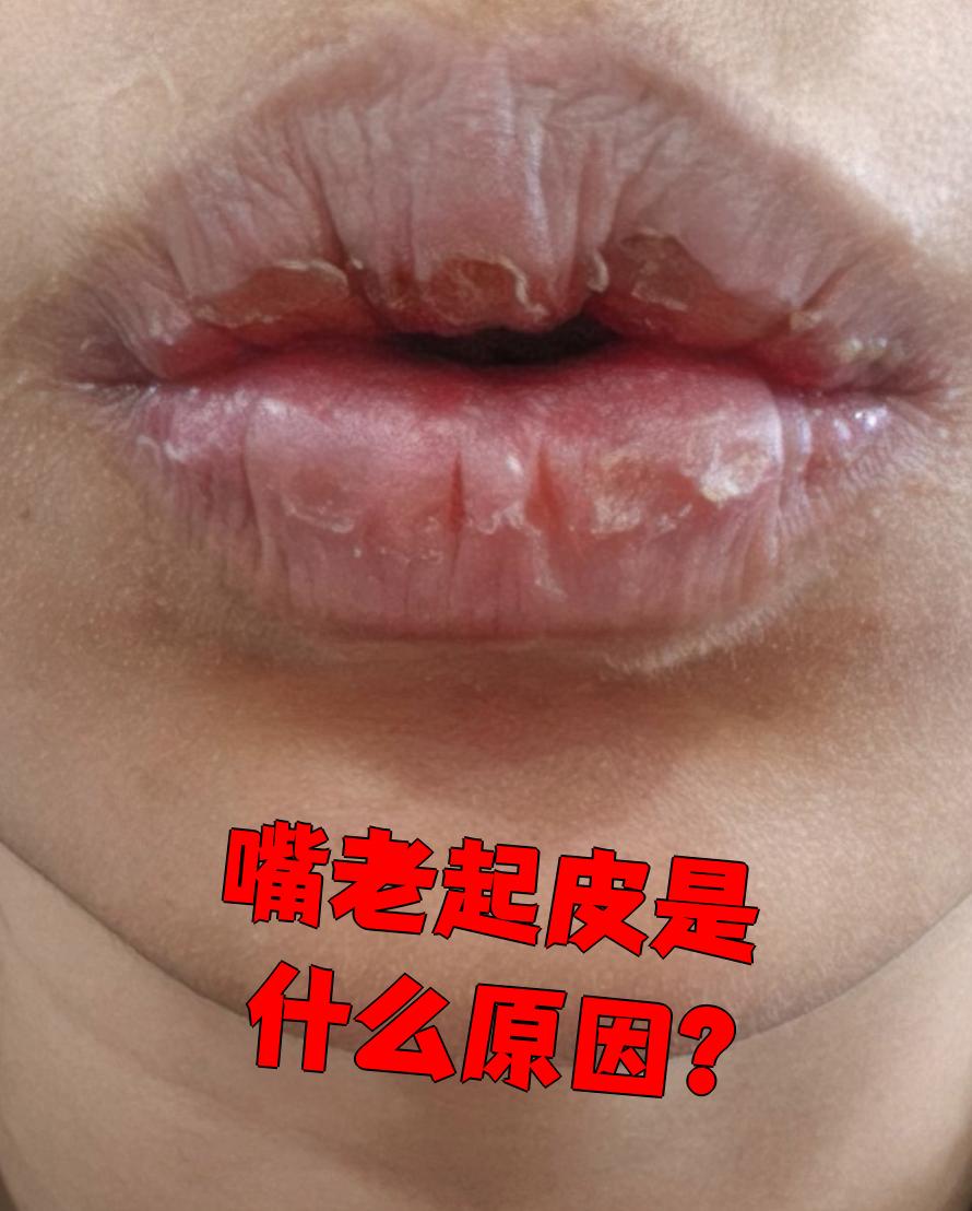 嘴皮肿了是怎么回事
