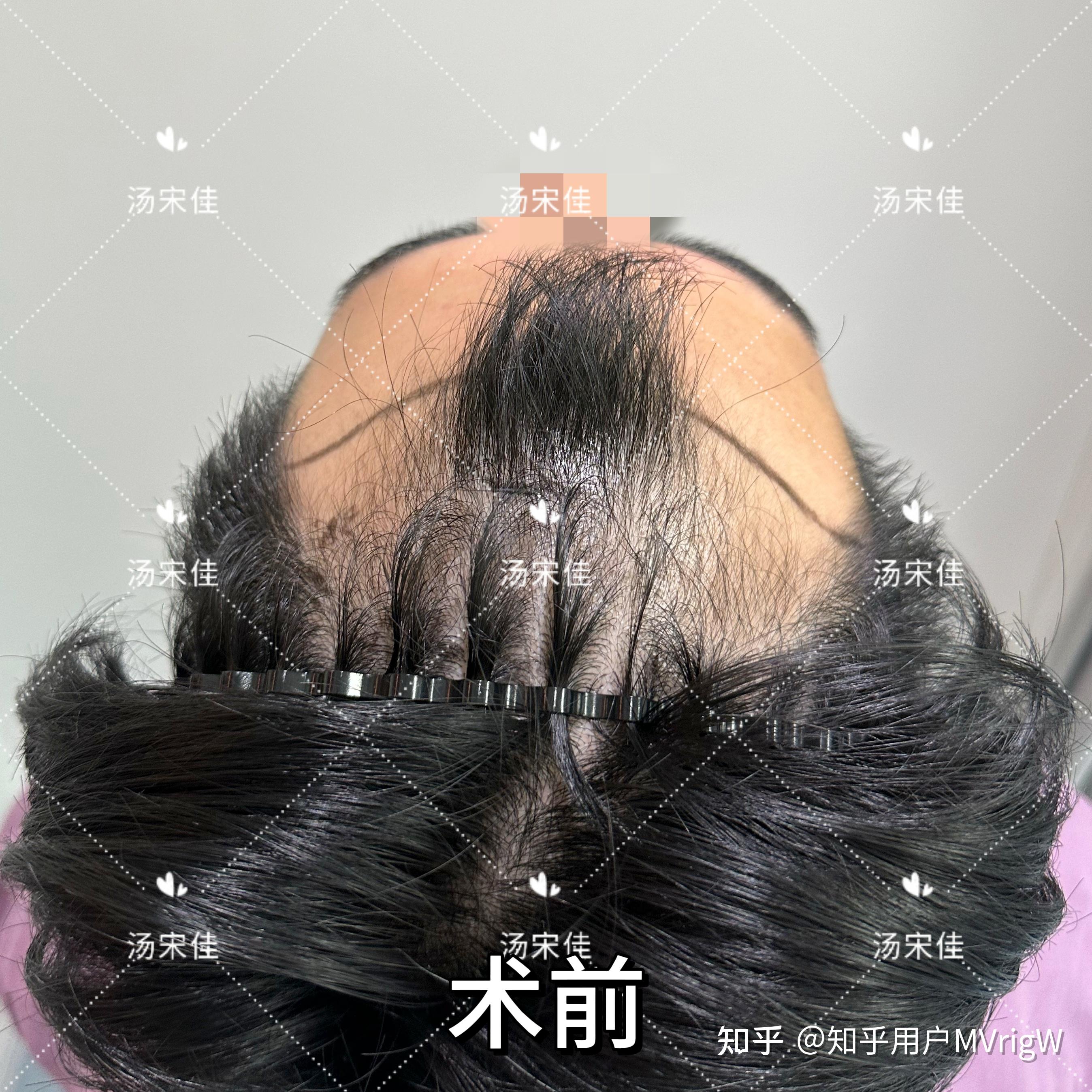 植发多少钱一个单位