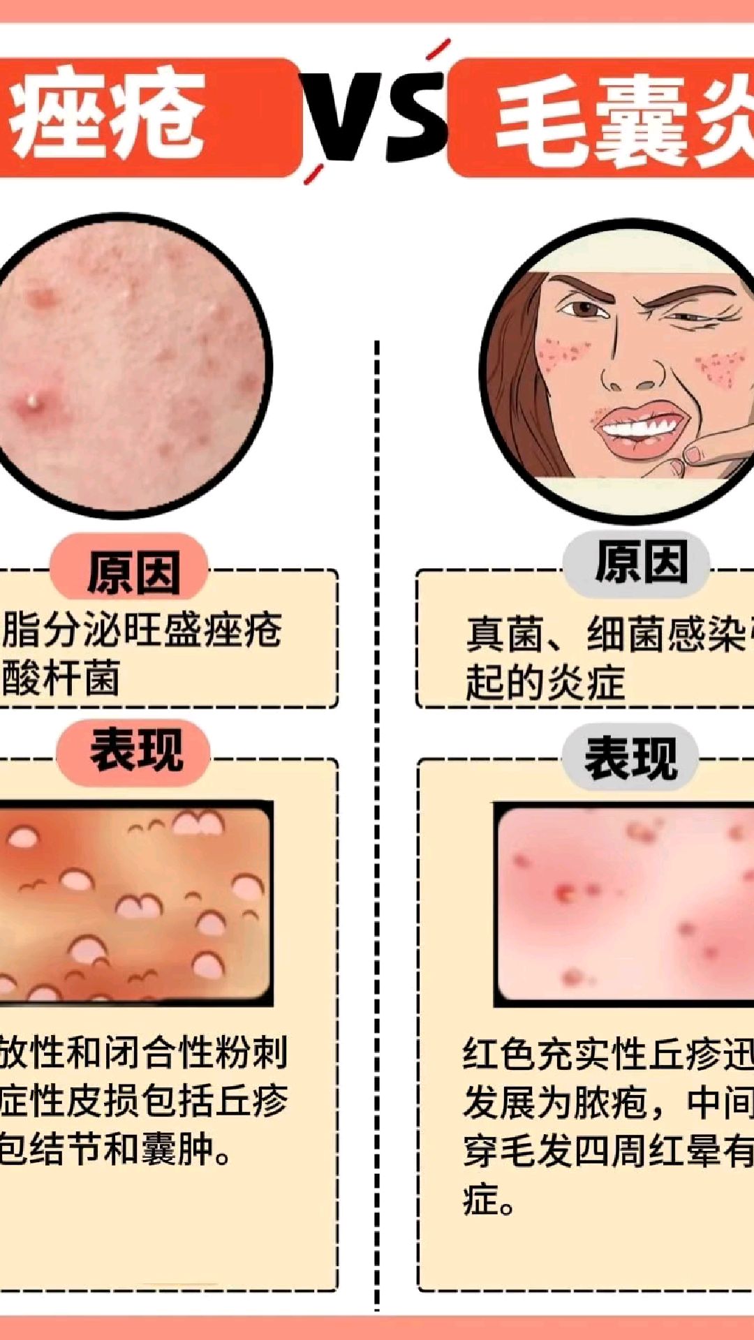什么是痤疮?
