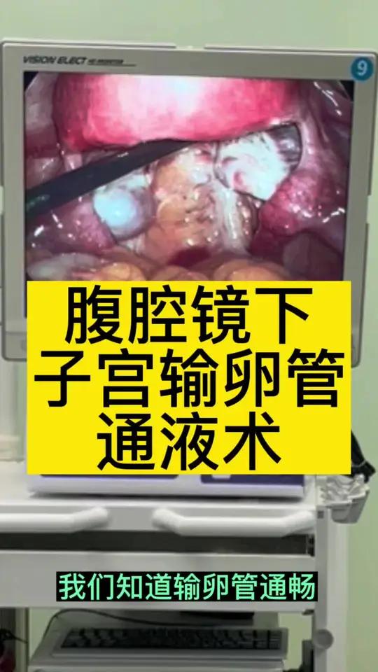 输卵管检查都有哪些?