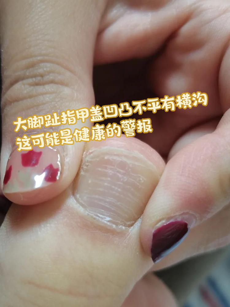 指甲盖凹凸不平是怎么回事