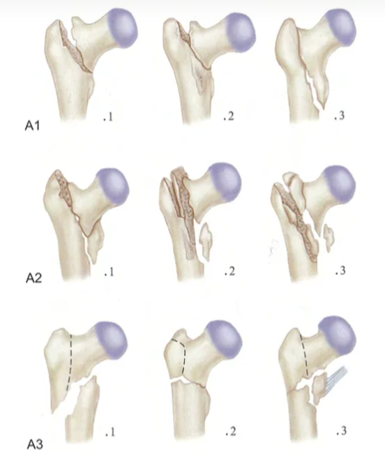 股骨粗隆间骨折临床表现
