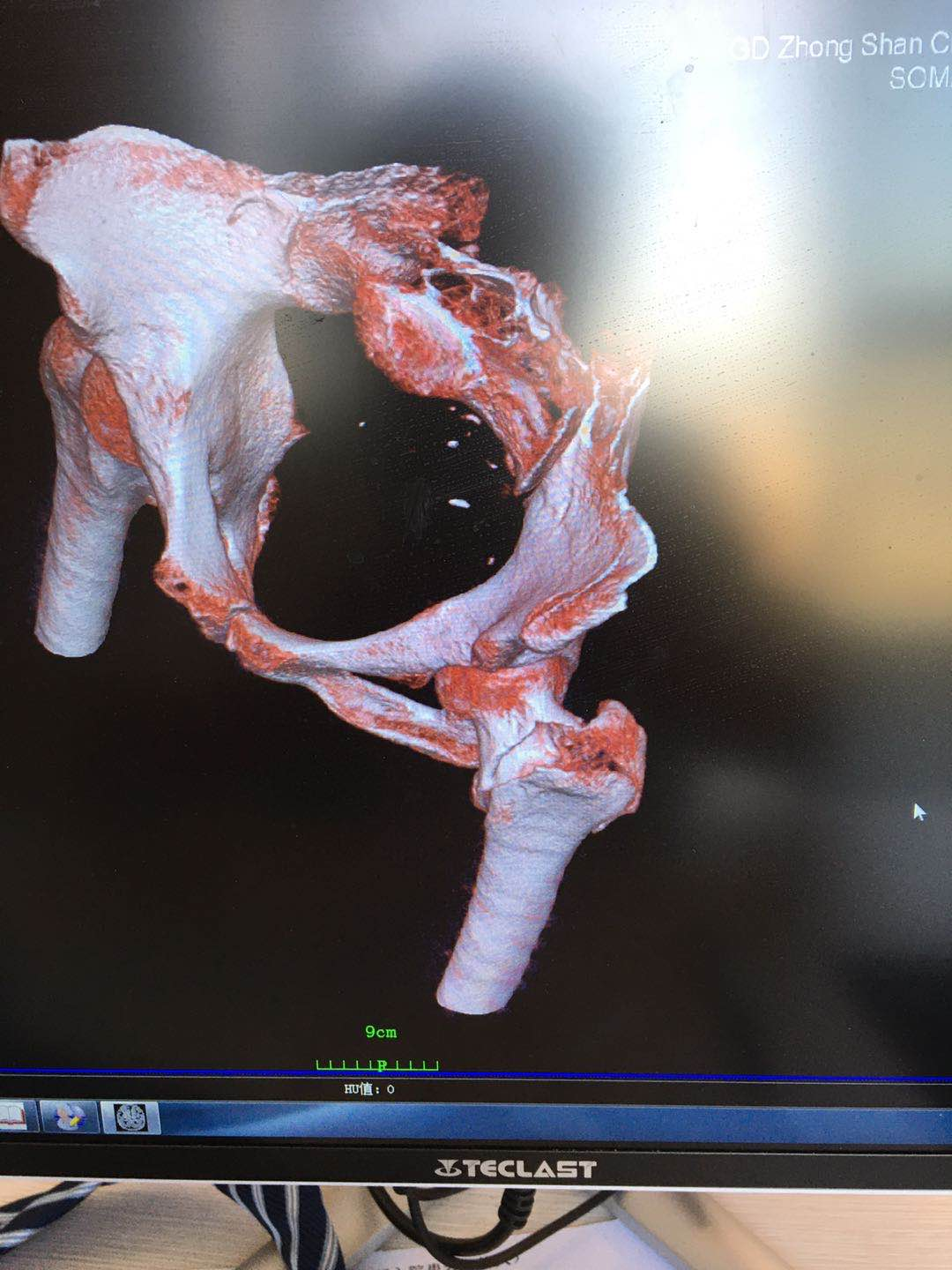 股骨粗隆间骨折临床表现