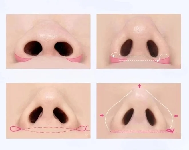 鼻孔可以缩小吗?