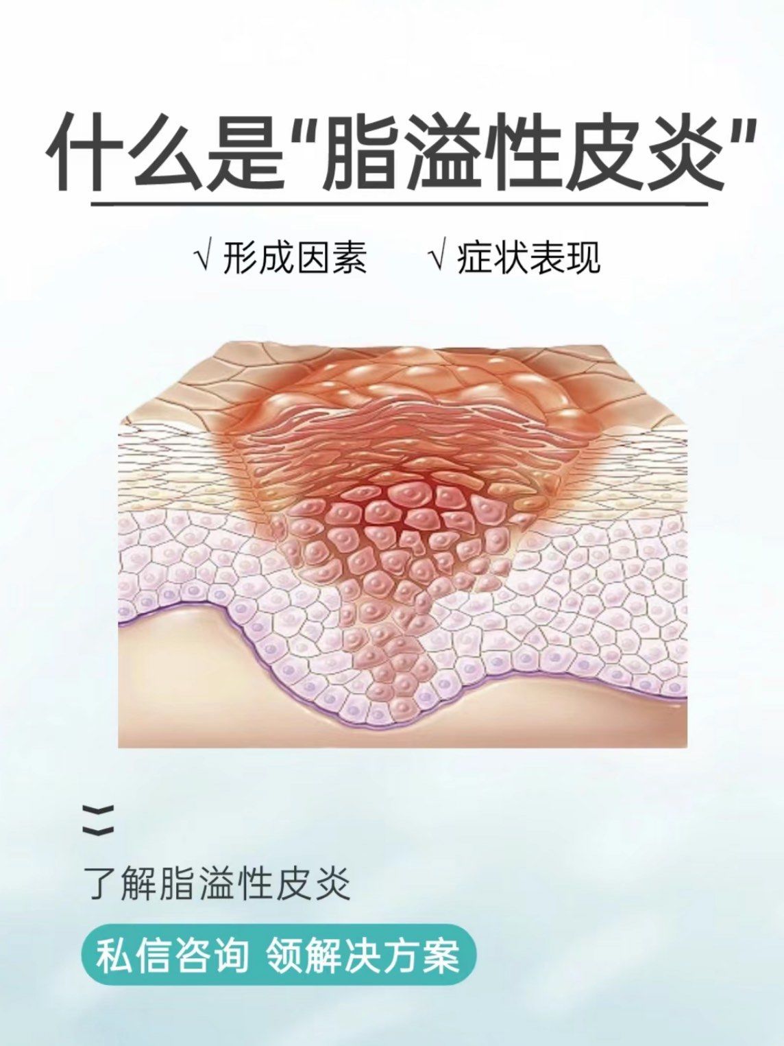 脂溢性皮炎会传染吗