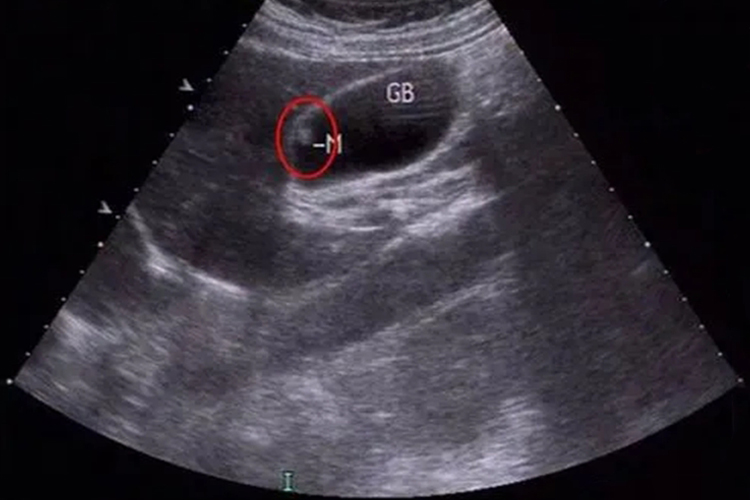 胆囊息肉样病变什么意思