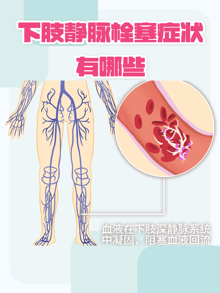 下肢静脉炎怎么回事啊