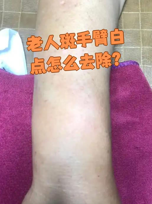 手臂出现小白点怎么办