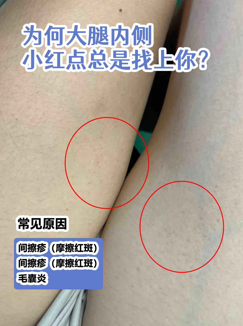 大腿内侧出现一片红斑不痛不痒