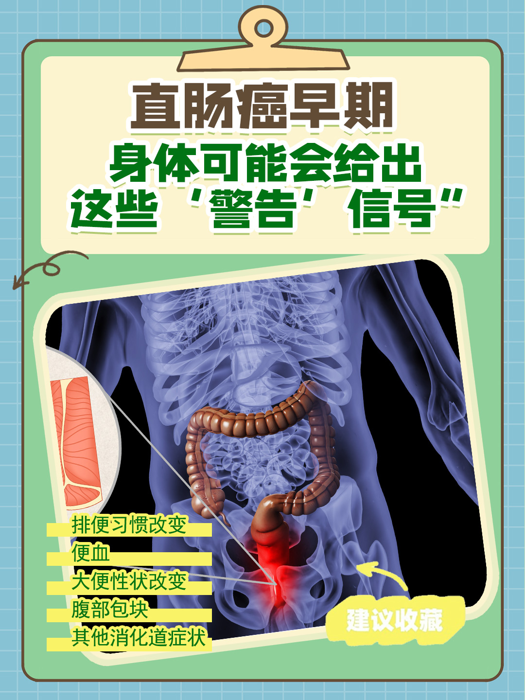 肠癌术后能活多久