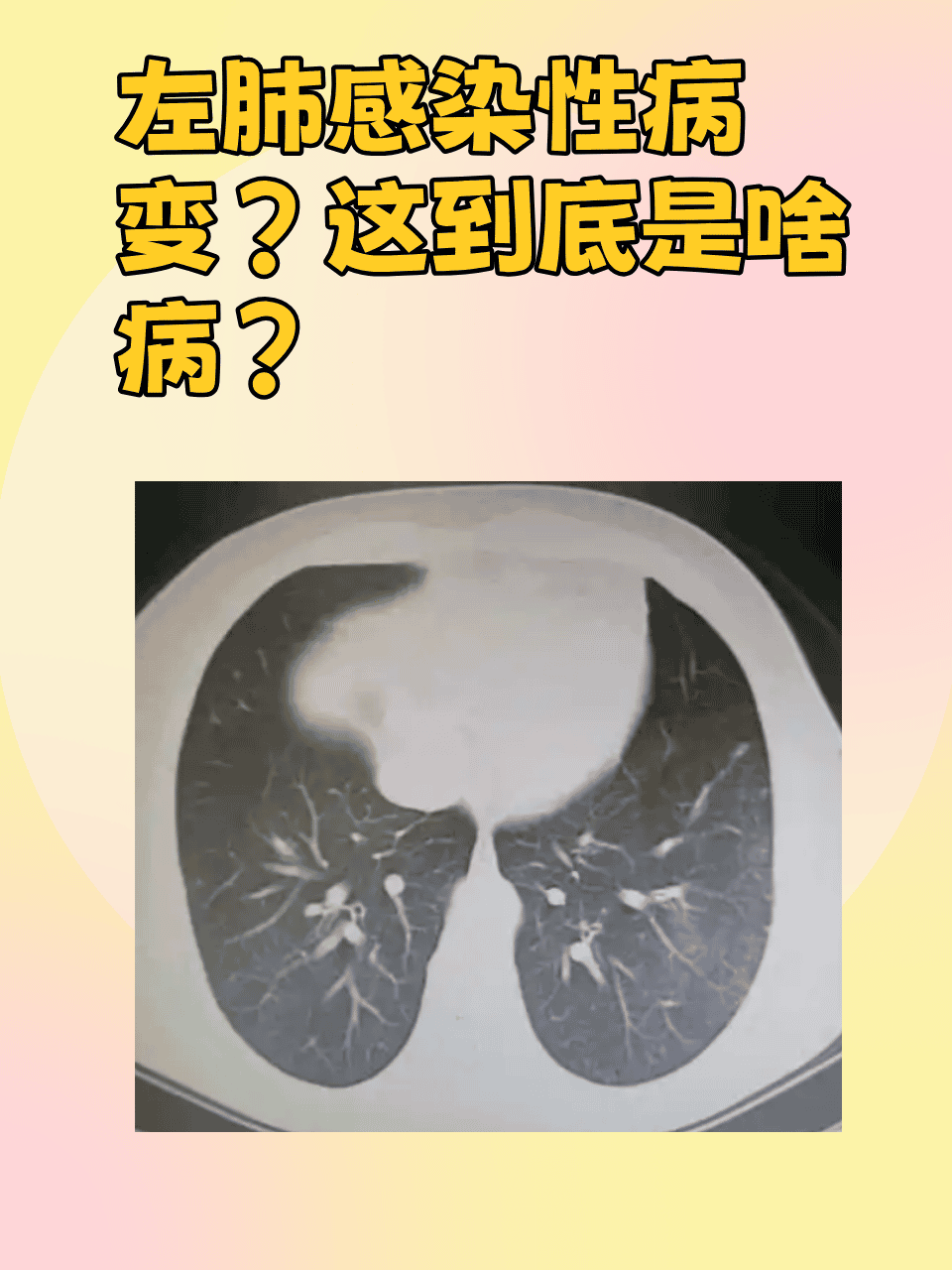 肺部感染有哪些症状