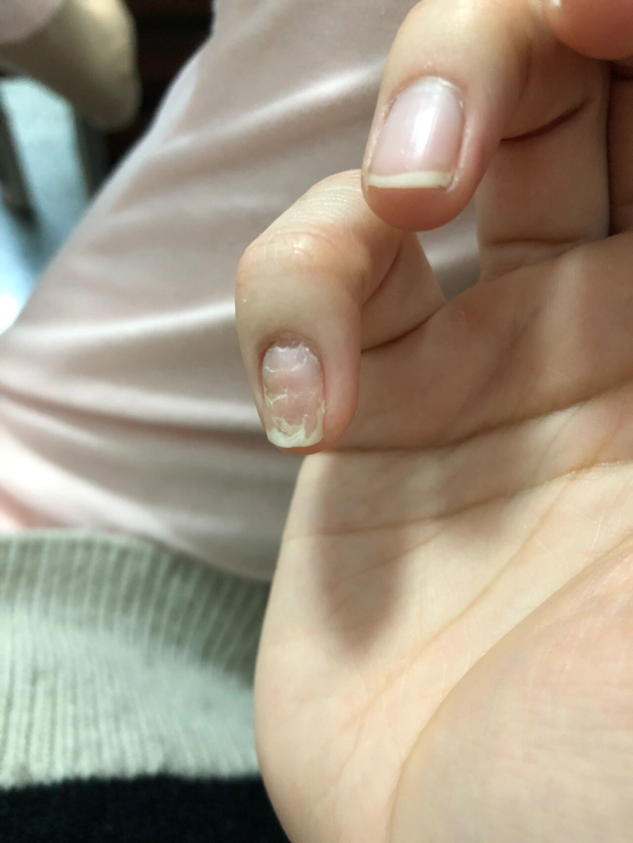 大母指指甲凹凸不平是怎么回事