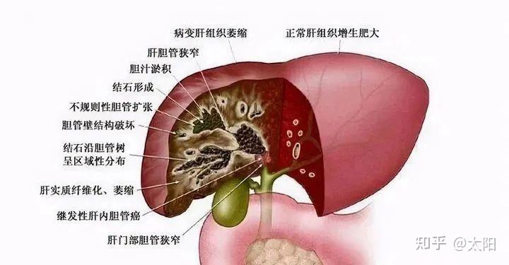 肝内胆管结石严重吗?
