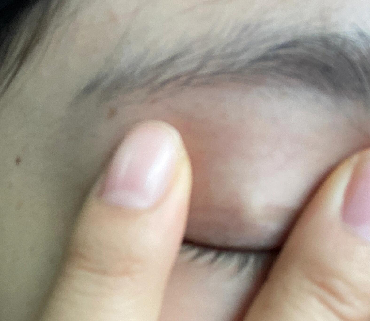 上眼皮里边长了一个小白点怎么办
