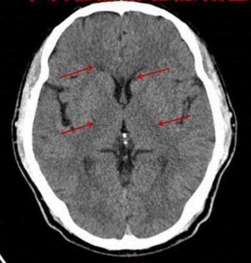 什么腔隙性脑梗塞