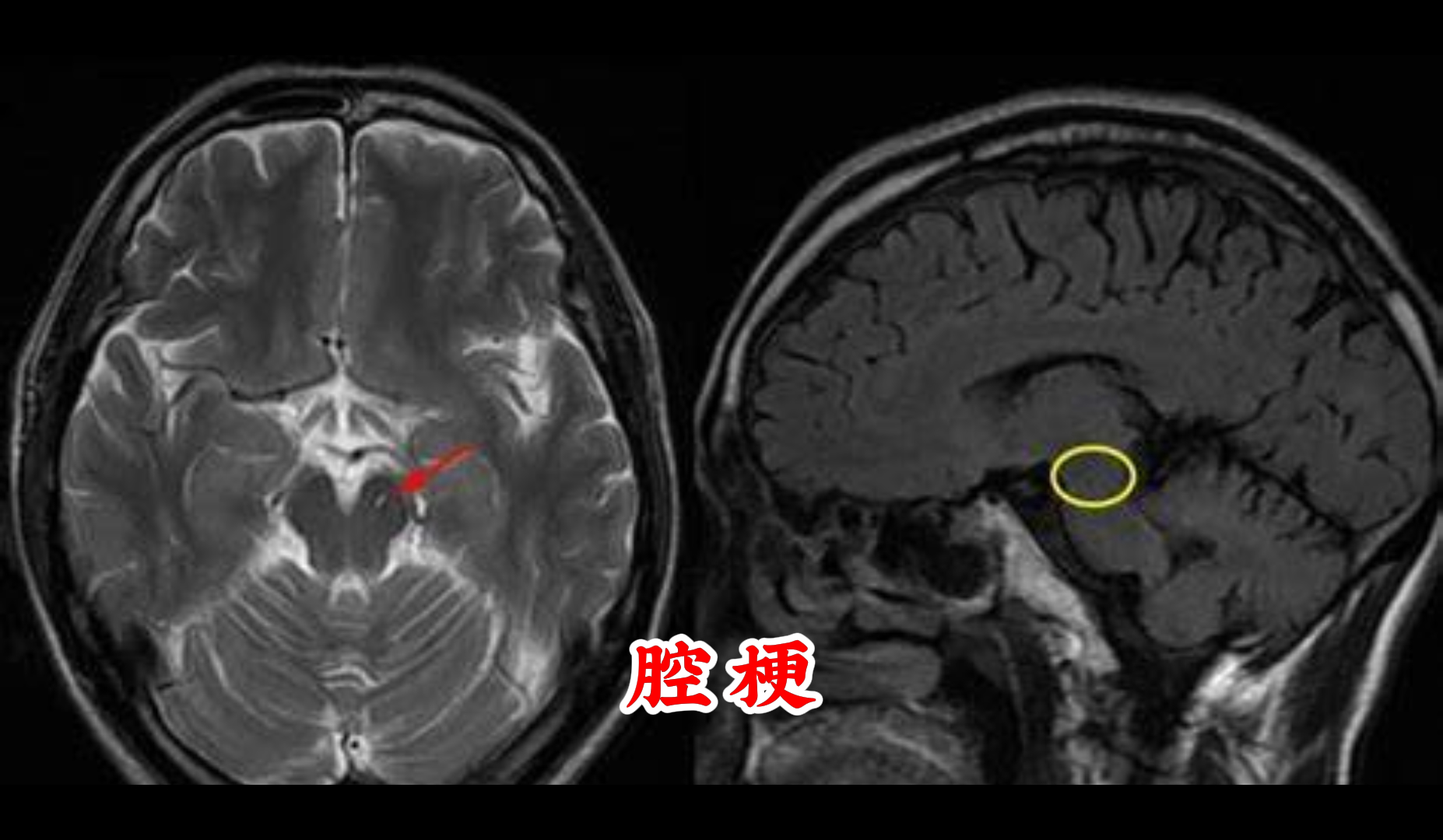 什么腔隙性脑梗塞
