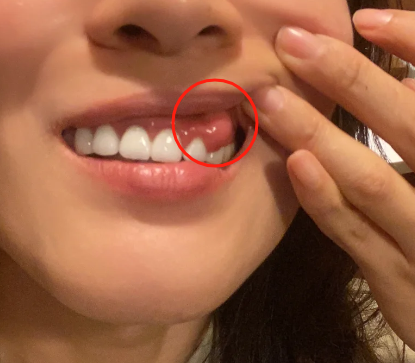 长智齿了,特别疼,牙龈发炎了肿了