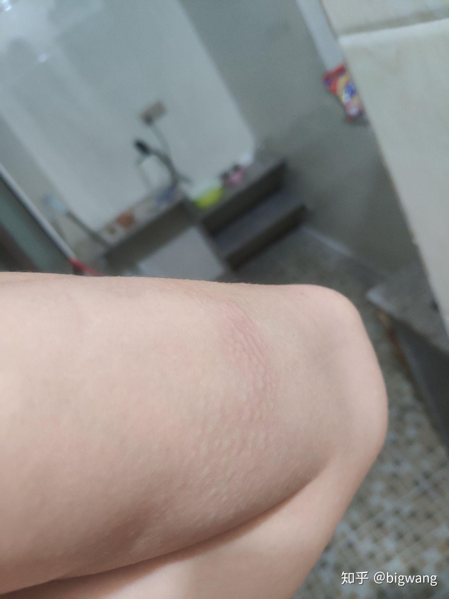 划痕性荨麻疹能自愈吗?