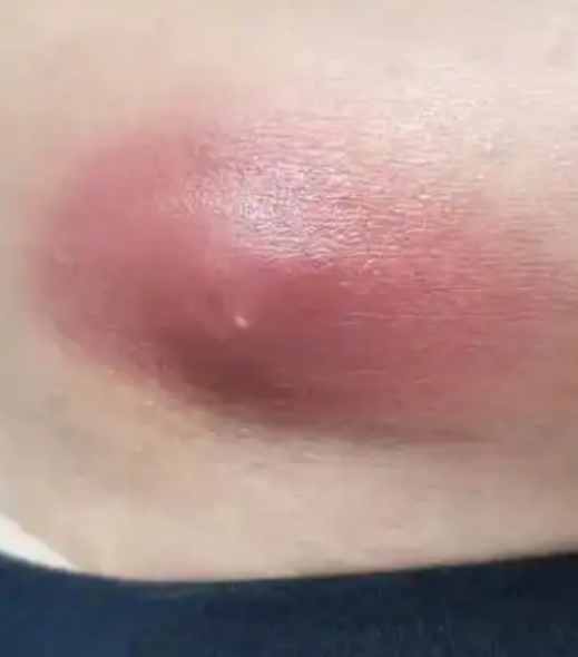 屁股上毛囊炎怎么办?