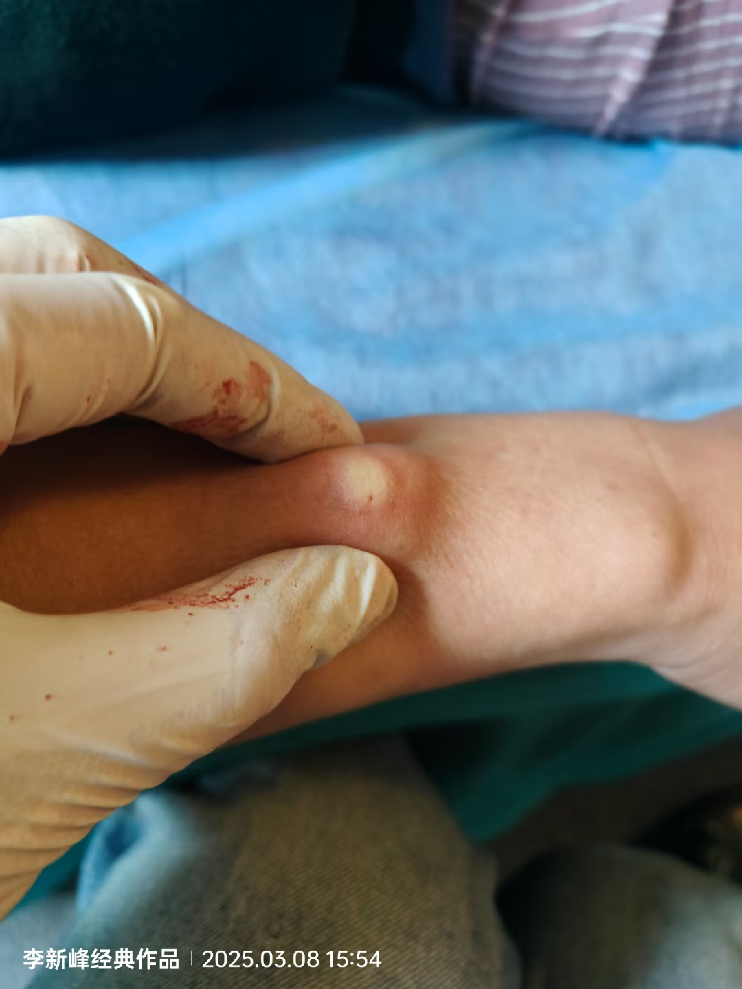 脂肪瘤切除需要住院吗