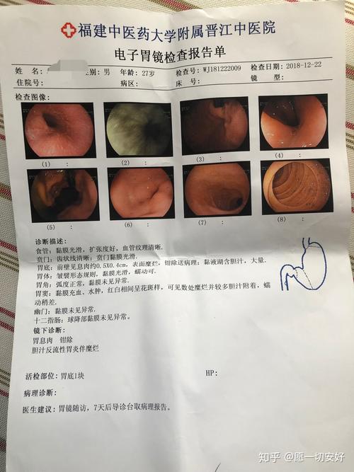 不做胃镜能查出来肠胃病吗