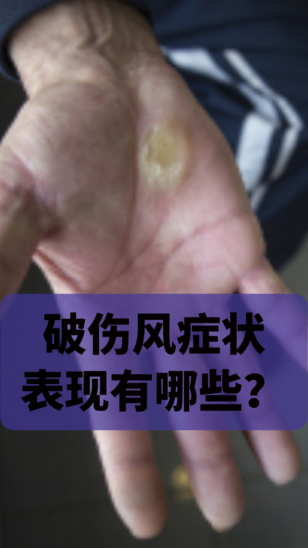 破伤风的症状有哪些?