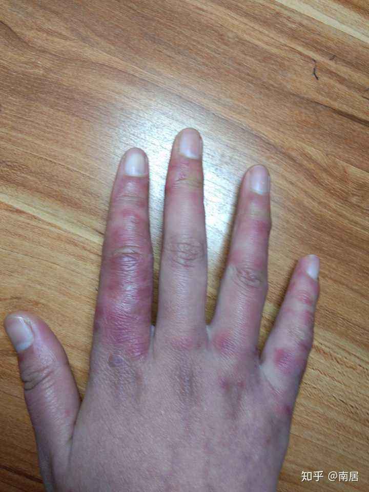 冬天手上长冻疮怎么治疗?