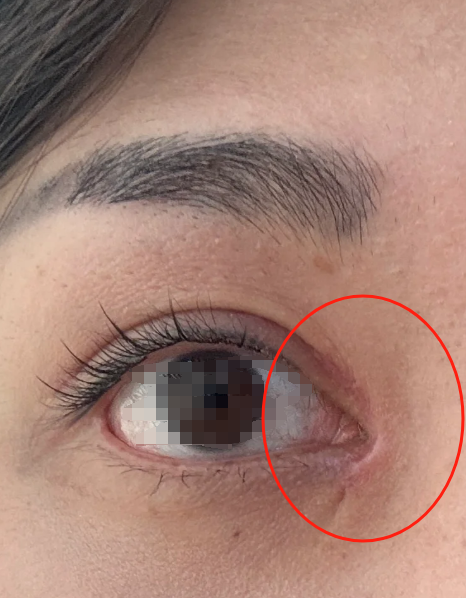 开眼角手术痛吗