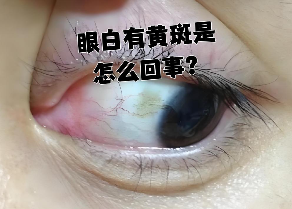 眼睛里有黄斑如何去除