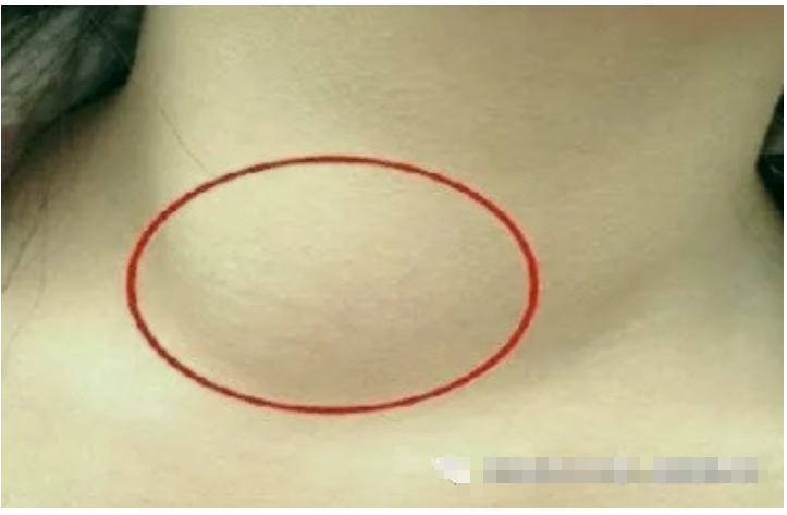 甲状腺囊肿会自己消失吗