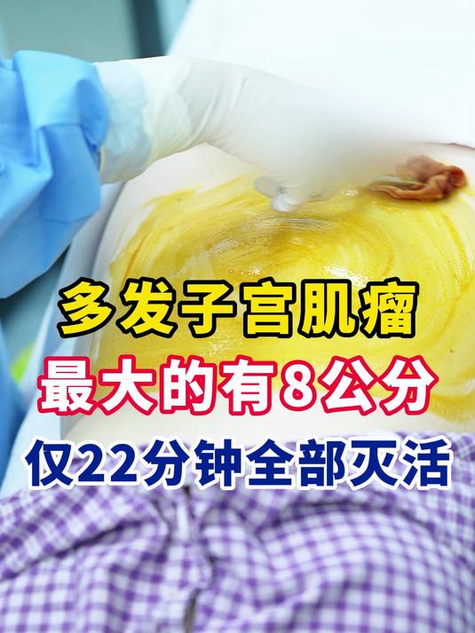 子宫多发肌瘤会癌变吗