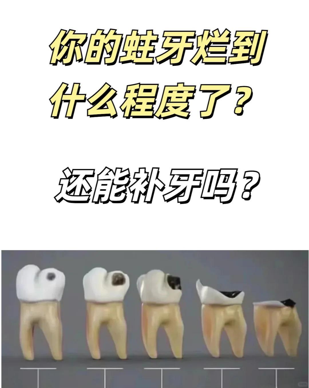 蛀牙一定要补牙吗